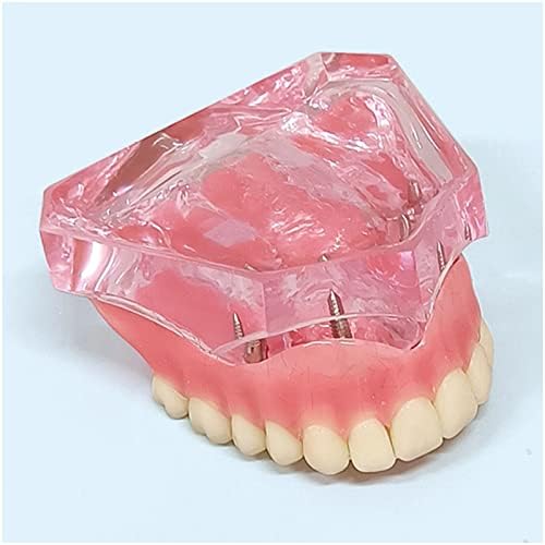 Модел на горните импланти на стоматолози KH66ZKY, 4 модел за реставрација на протеза на микро-имплантација, стоматолошки максиларен модел