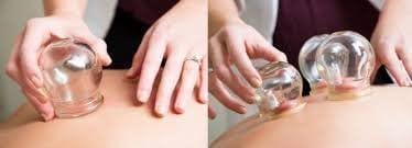 Кинеска терапија за масажа. Сет од 5 чаши за масажа за стакло. Заглавувачки тегли, СССР од СССР